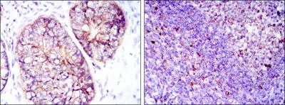 Immunohistochemical analysis of paraffin-embedded prostate cancer tissues (left) and tonsil tissues (right) using EEF2 mouse mAb with DAB staining.