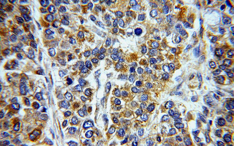 Immunohistochemical of paraffin-embedded human liver cancer using Catalog No:109984(DKK3 antibody) at dilution of 1:50 (under 40x lens)