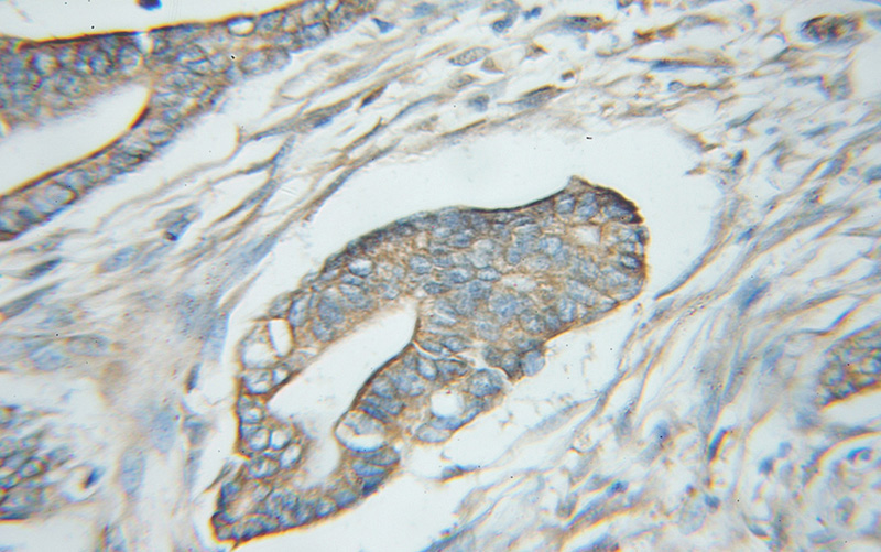 Immunohistochemical of paraffin-embedded human pancreas cancer using Catalog No:111571(HSP90AB1 antibody) at dilution of 1:50 (under 10x lens)