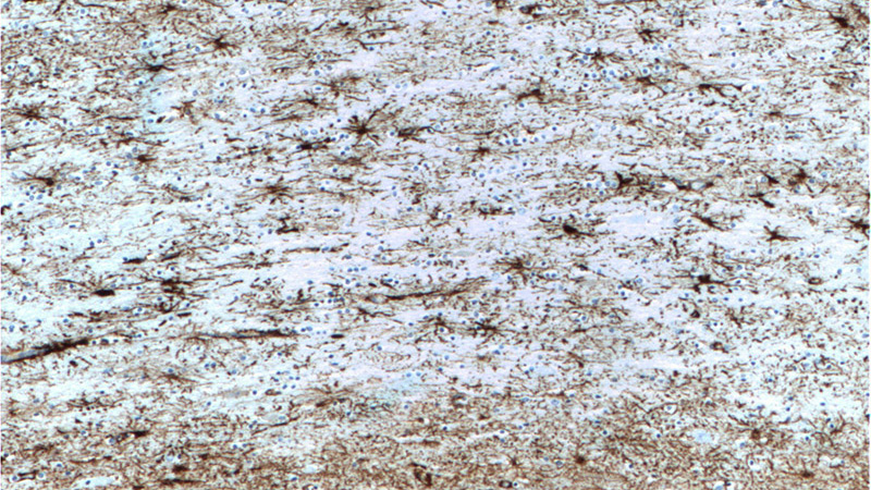 Immunohistochemistry of paraffin-embedded human brain tissue slide using Catalog No:107295(GFAP Antibody) at dilution of 1:5000 (under 10x lens). Heat mediated antigen retrieved with Citric acid buffer, pH6.0.
