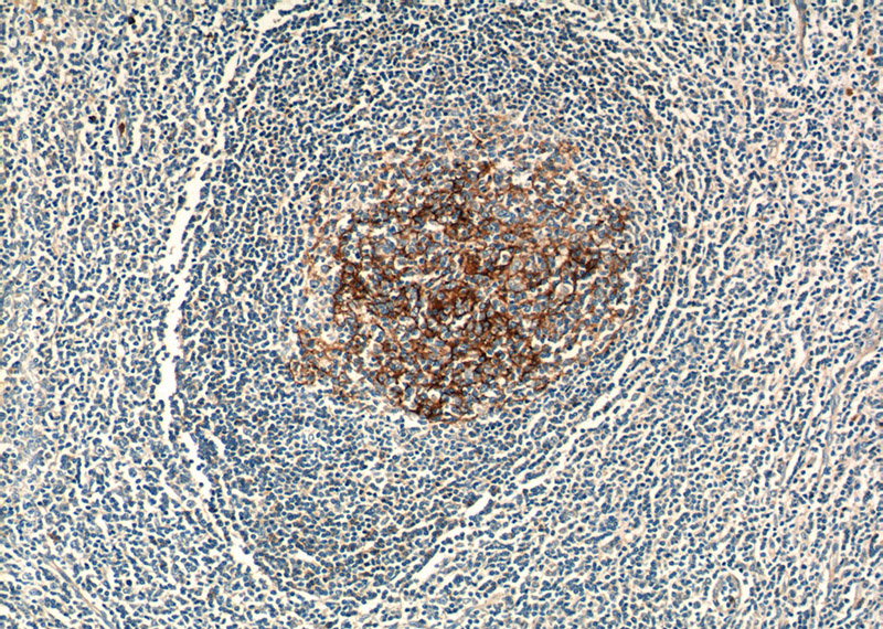 Immunohistochemistry of paraffin-embedded human tonsillitis tissue slide using Catalog No:109010(FCER2,CD23 Antibody) at dilution of 1:50 (under 10x lens)