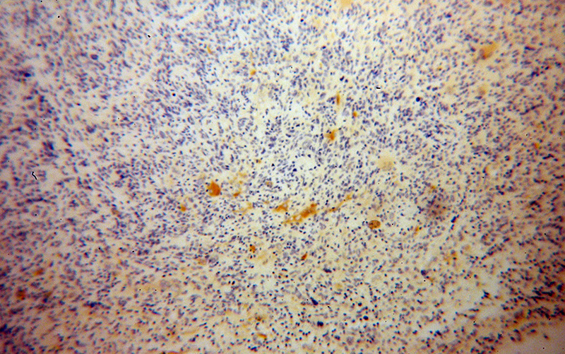 Immunohistochemical of paraffin-embedded human gliomas using Catalog No:110951(GFPT1 antibody) at dilution of 1:100 (under 10x lens)