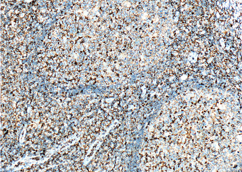 Immunohistochemistry of paraffin-embedded human tonsillitis tissue slide using (CD11a/Integrin alpha-L Antibody) at dilution of 1:500 (under 10x lens). heat mediated antigen retrieved with Tris-EDTA buffer(pH9).