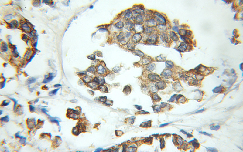 Immunohistochemical of paraffin-embedded human breast cancer using Catalog No:107836(AGR3 antibody) at dilution of 1:50 (under 10x lens)