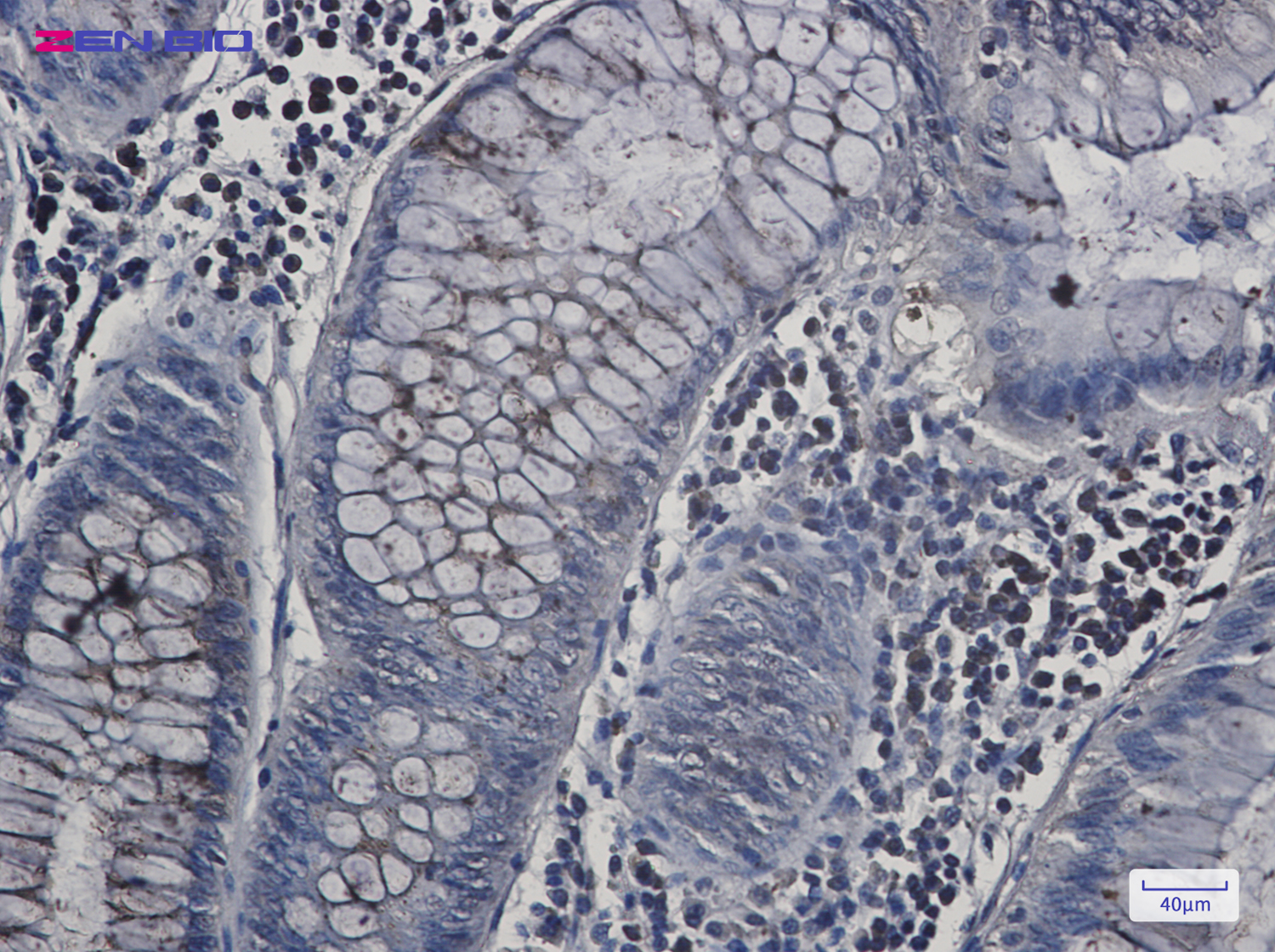 Immunohistochemistry of N-WASP in paraffin-embedded Human colon cancer tissue using N-WASP Rabbit pAb at dilution 1/20