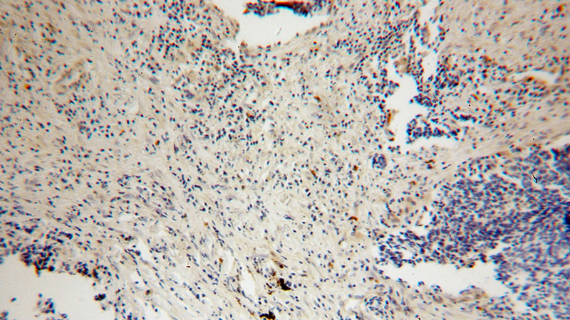 Immunohistochemical of paraffin-embedded human lung cancer using Catalog No:111413(HK3 antibody) at dilution of 1:100 (under 10x lens)