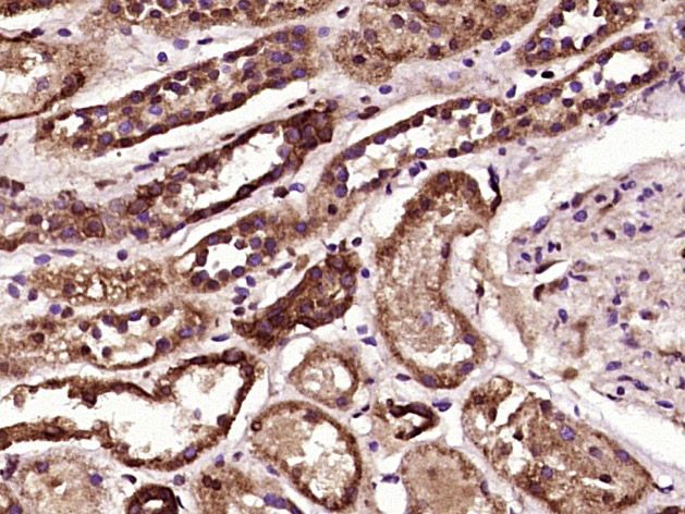 Fig4: Paraformaldehyde-fixed, paraffin embedded (Human kidney tissue); Antigen retrieval by boiling in sodium citrate buffer (pH6.0) for 15min; Block endogenous peroxidase by 3% hydrogen peroxide for 20 minutes; Blocking buffer (normal goat serum) at 37℃ for 30min; Antibody incubation with (PTPD1) Polyclonal Antibody, Unconjugated at 1:400 overnight at 4℃, followed by operating according to SP Kit(Rabbit) (sp-0023) instructionsand DAB staining.