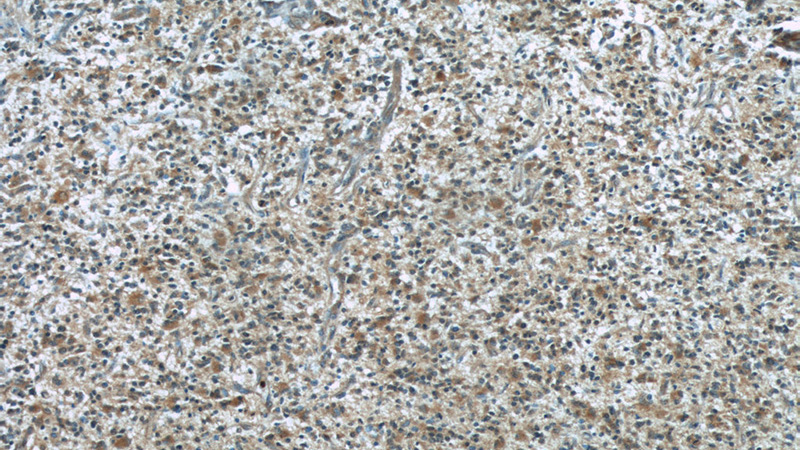 Immunohistochemical of paraffin-embedded human gliomas using Catalog No:107083(BCS1L antibody) at dilution of 1:50 (under 10x lens)
