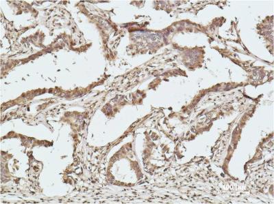 Immunohistochemical analysis of paraffin-embedded human breast caricnoma using Histone H2B uff08uff09Mouse mAb diluted at 1:500.