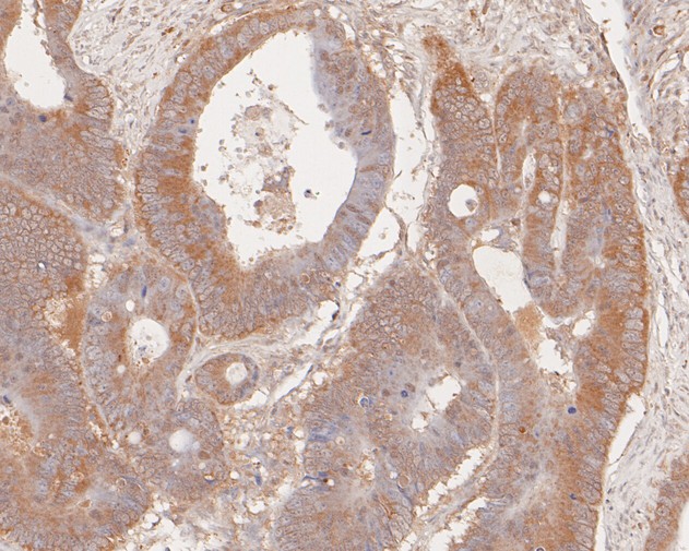 Fig5:; Immunohistochemical analysis of paraffin-embedded human colon carcinoma tissue using anti-cGAS antibody. The section was pre-treated using heat mediated antigen retrieval with sodium citrate buffer (pH 6.0) for 20 minutes. The tissues were blocked in 5% BSA for 30 minutes at room temperature, washed with ddH; 2; O and PBS, and then probed with the primary antibody ( 1/200) for 30 minutes at room temperature. The detection was performed using an HRP conjugated compact polymer system. DAB was used as the chromogen. Tissues were counterstained with hematoxylin and mounted with DPX.