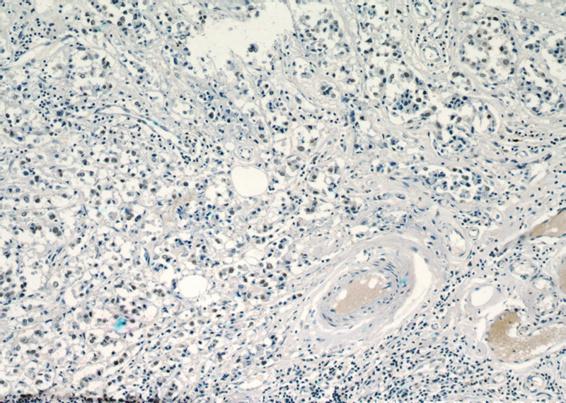 Immunohistochemical of paraffin-embedded human breast cancer using Catalog No:115660(SR140 antibody) at dilution of 1:100 (under 10x lens)