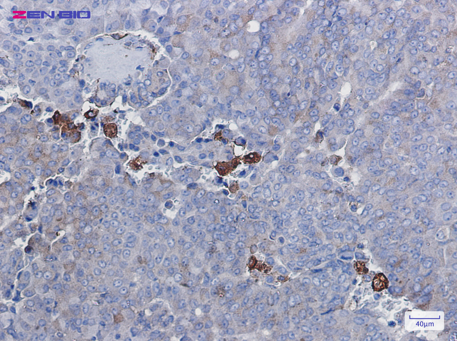 Immunohistochemistry of Amyloid Precursor Protein in paraffin-embedded Human breast cancer tissue using Amyloid Precursor Protein Rabbit pAb at dilution 1/100