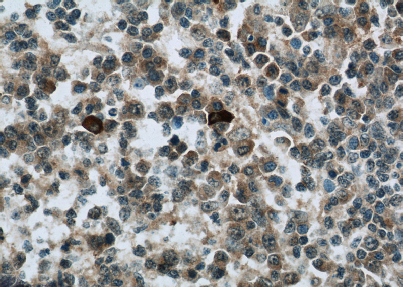 Immunohistochemistry of paraffin-embedded human tonsillitis tissue slide using Catalog No:114732(RNASEL Antibody) at dilution of 1:50 (under 40x lens)