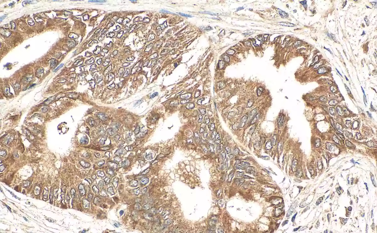 IHC staining of human pancreas cancer