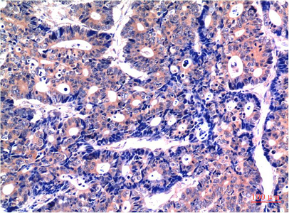 Immunohistochemical analysis of paraffin-embedded Human Stomach Carcinoma Tissue using GSK3β Mouse mAb diluted at 1:200.