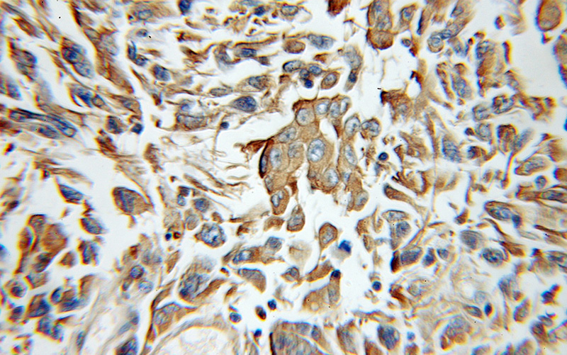 Immunohistochemical of paraffin-embedded human gliomas using Catalog No:116167(TOLLIP antibody) at dilution of 1:100 (under 10x lens)