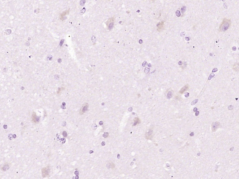 Fig1:; Immunohistochemical analysis of paraffin-embedded human brain glioma using anti-CH25H antibody. The section was pre-treated using heat mediated antigen retrieval with Tris-EDTA buffer (pH 8.0-8.4) for 20 minutes.The tissues were blocked in 5% BSA for 30 minutes at room temperature, washed with ddH; 2; O and PBS, and then probed with the primary antibody ( 1/100) for 30 minutes at room temperature. The detection was performed using an HRP conjugated compact polymer system. DAB was used as the chromogen. Tissues were counterstained with hematoxylin and mounted with DPX.