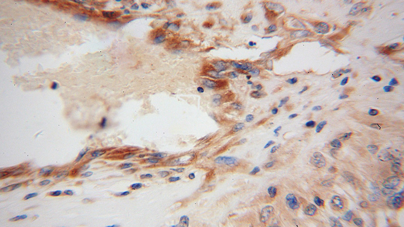 Immunohistochemical of paraffin-embedded human gliomas using Catalog No:113532(p115, USO1 antibody) at dilution of 1:100 (under 40x lens)
