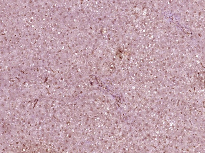 Fig2: Paraformaldehyde-fixed, paraffin embedded (Rat liver); Antigen retrieval by boiling in sodium citrate buffer (pH6.0) for 15min; Block endogenous peroxidase by 3% hydrogen peroxide for 20 minutes; Blocking buffer (normal goat serum) at 37℃ for 30min; Antibody incubation with (HNF1A) Polyclonal Antibody, Unconjugated at 1:400 overnight at 4℃, followed by operating according to SP Kit(Rabbit) (sp-0023) instructionsand DAB staining.