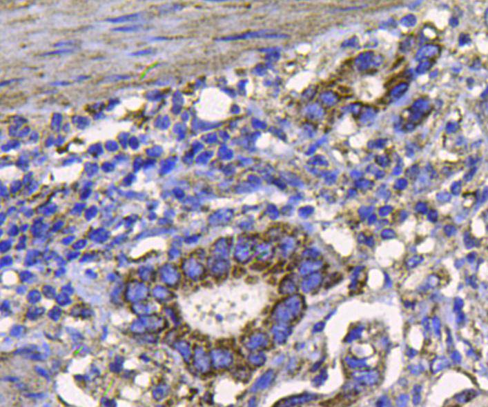 Fig5: Immunohistochemical analysis of paraffin-embedded human stomach carcinoma tissue using anti-FGFR2 antibody. Counter stained with hematoxylin.