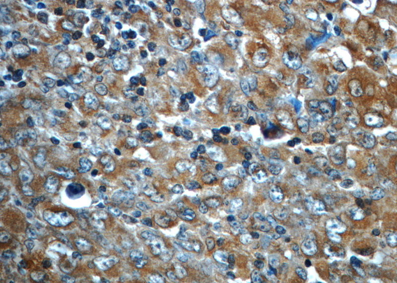 Immunohistochemistry of paraffin-embedded human lymphoma slide using (ALK,CD246 Antibody) at dilution of 1:50
