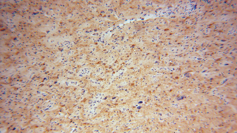 Immunohistochemical of paraffin-embedded human gliomas using Catalog No:110135(DYNC1I1 antibody) at dilution of 1:50 (under 10x lens)