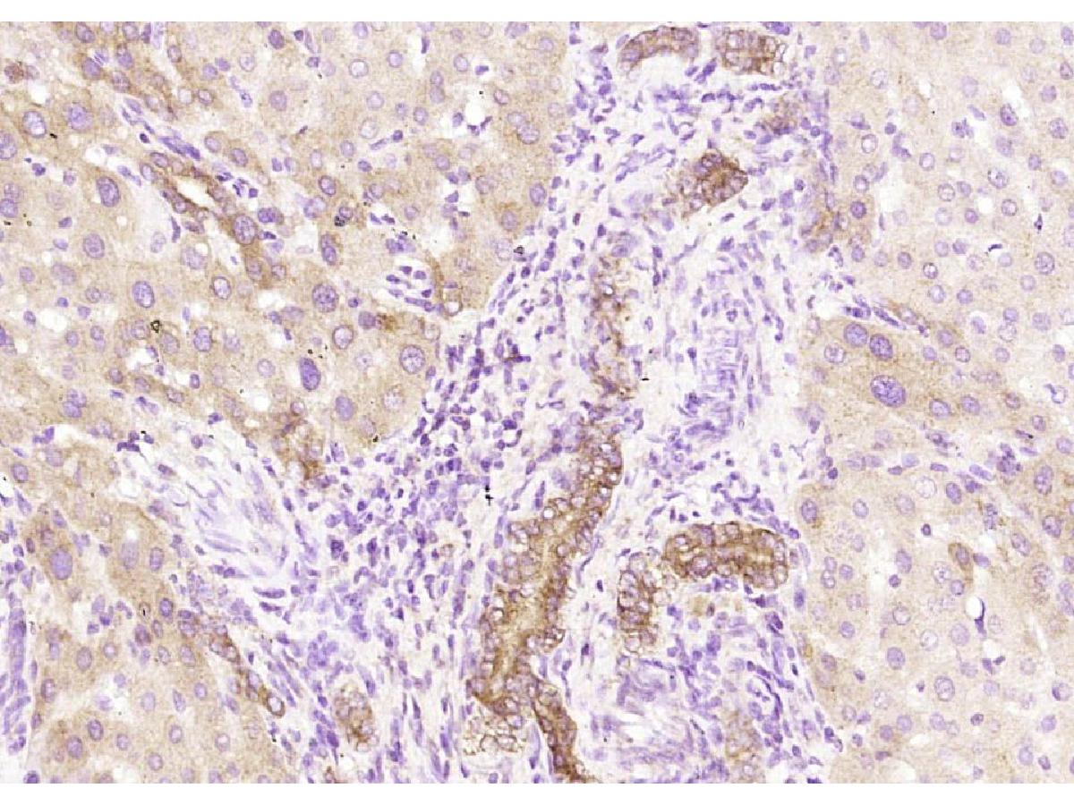 Fig6: Paraformaldehyde-fixed, paraffin embedded (human liver); Antigen retrieval by boiling in sodium citrate buffer (pH6.0) for 15min; Block endogenous peroxidase by 3% hydrogen peroxide for 20 minutes; Blocking buffer (normal goat serum) at 37℃ for 30min; Antibody incubation with (Pan Cytokeratin) Polyclonal Antibody, Unconjugated at 1:200 overnight at 4℃, followed by operating according to SP Kit(Rabbit) (sp-0023) instructionsand DAB staining.