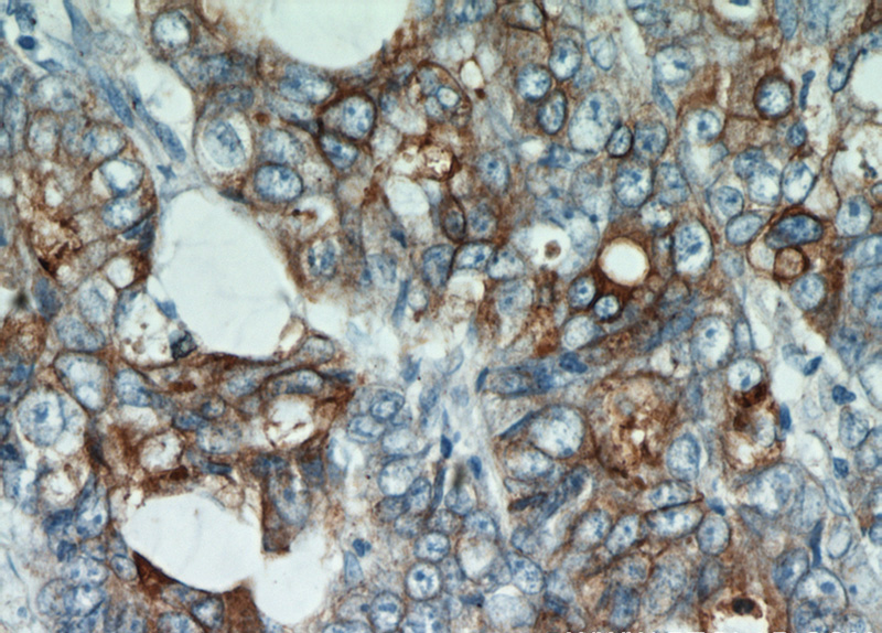 Immunohistochemical of paraffin-embedded human colon cancer using Catalog No:109242(CEA antibody) at dilution of 1:50 (under 40x lens)
