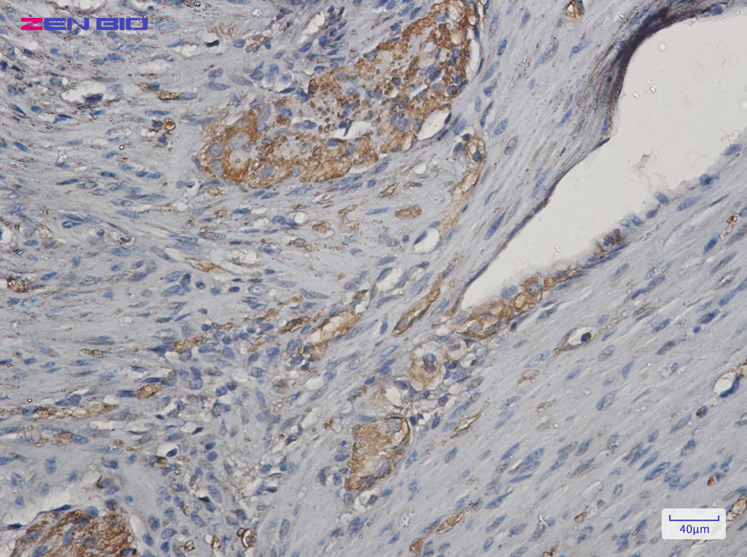 Immunohistochemistry of NEK9 in paraffin-embedded Human colon cancer tissue using NEK9 Rabbit pAb at dilution 1/20