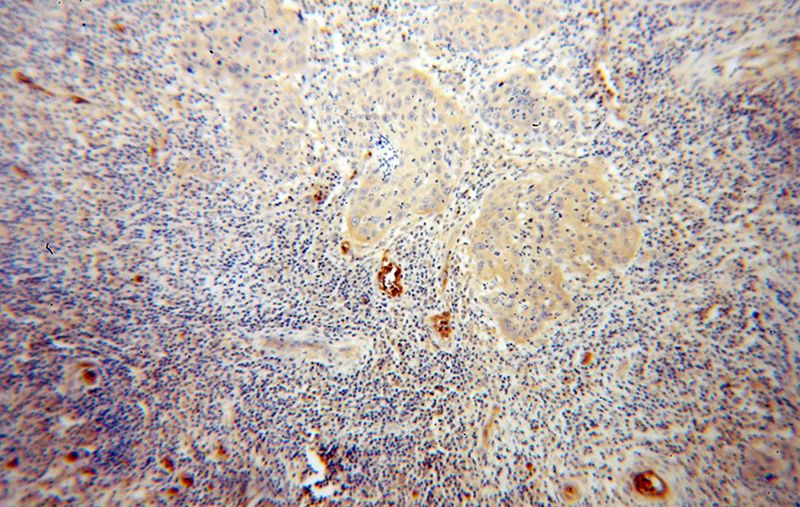 Immunohistochemical of paraffin-embedded human cervical cancer using Catalog No:108403(BACH1 antibody) at dilution of 1:100 (under 10x lens)