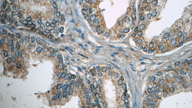 Immunohistochemistry of paraffin-embedded human prostate hyperplasia tissue slide using Catalog No:116858 (WDR19 Antibody) at dilution of 1:50