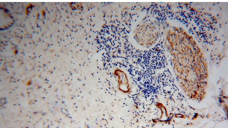 Immunohistochemical of paraffin-embedded human pancreas cancer using Catalog No:108004(AMPH antibody) at dilution of 1:100 (under 10x lens)