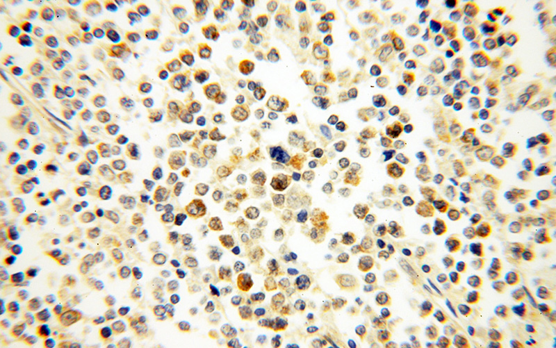 Immunohistochemical of paraffin-embedded human lymphoma using Catalog No:113285(WHSC1L1 antibody) at dilution of 1:50 (under 40x lens)