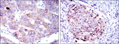 Immunohistochemical analysis of paraffin-embedded liver cancer tissues (left) and kidney cancer tissues (right) using EEF2 mouse mAb with DAB staining.