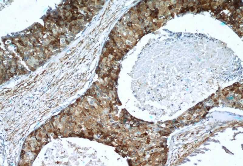 Immunohistochemistry of paraffin-embedded human breast cancer tissue slide using Catalog No:113610(PXN Antibody) at dilution of 1:50 (under 10x lens)