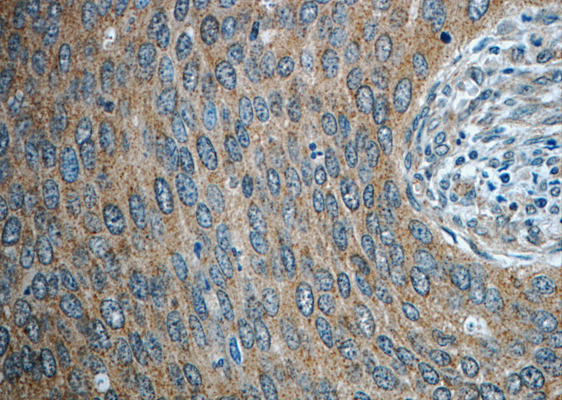 Immunohistochemistry of paraffin-embedded human cervical cancer slide using Catalog No:115688(STAT3 Antibody) at dilution of 1:50