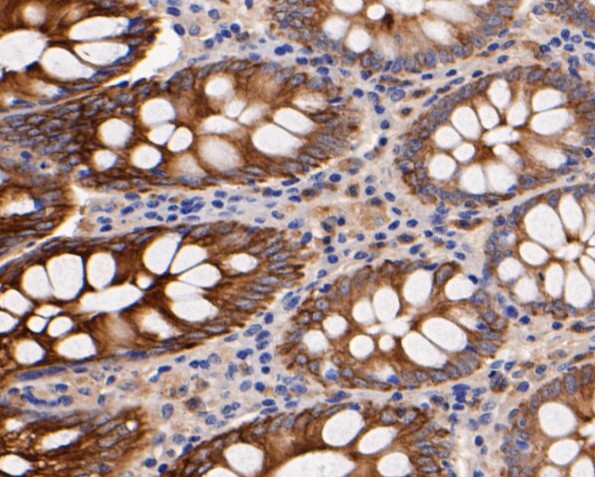 Fig5: Immunohistochemical analysis of paraffin-embedded human colon tissue using anti-CD68 antibody. The section was pre-treated using heat mediated antigen retrieval with Tris-EDTA buffer (pH 8.0-8.4) for 20 minutes.The tissues were blocked in 5% BSA for 30 minutes at room temperature, washed with ddH2O and PBS, and then probed with the primary antibody ( 1/50) for 30 minutes at room temperature. The detection was performed using an HRP conjugated compact polymer system. DAB was used as the chromogen. Tissues were counterstained with hematoxylin and mounted with DPX.