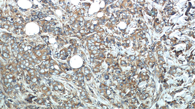 Immunohistochemistry of paraffin-embedded human breast cancer slide using Catalog No:109799(KRT18 Antibody) at dilution of 1:50