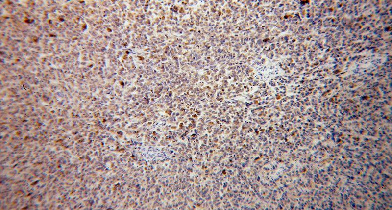 Immunohistochemical of paraffin-embedded human malignant melanoma using Catalog No:116808(VTI1B antibody) at dilution of 1:100 (under 10x lens)