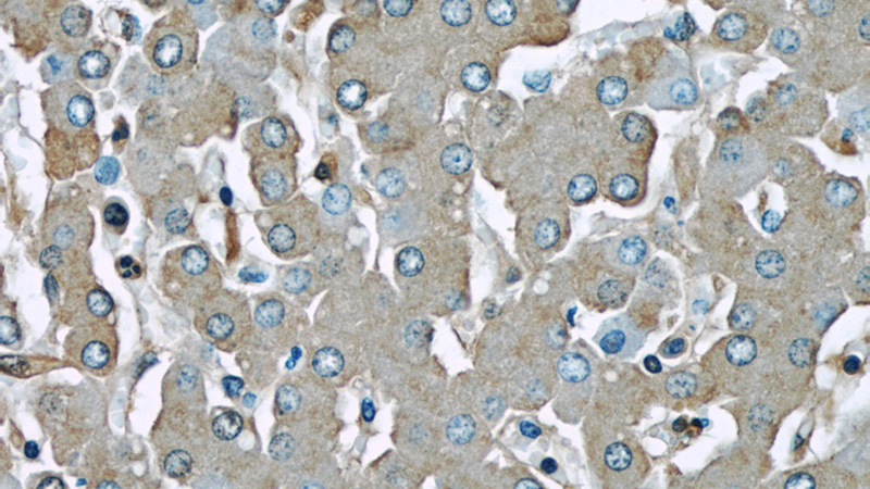 Immunohistochemical of paraffin-embedded human liver using Catalog No:107875(Alpha-1-Antitrypsin antibody) at dilution of 1:50 (under 40x lens)