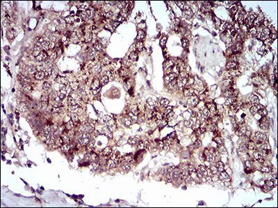 Immunohistochemical analysis of paraffin-embedded esophageal cancer tissues using PDK2 mouse mAb with DAB staining.