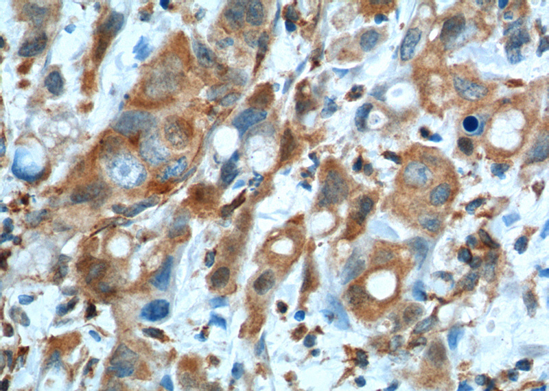 Immunohistochemistry of paraffin-embedded human liver cancer tissue slide using Catalog No:107304(GOT1 Antibody) at dilution of 1:200 (under 40x lens). heat mediated antigen retrieved with Tris-EDTA buffer(pH9).