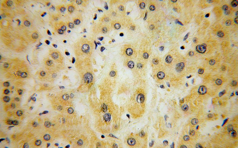 Immunohistochemical of paraffin-embedded human liver cancer using Catalog No:115771(SYT1 antibody) at dilution of 1:100 (under 40x lens)