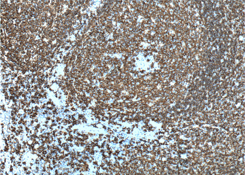 Immunohistochemistry of paraffin-embedded human tonsillitis tissue slide using Catalog No:107050(MS4A1,CD20 Antibody) at dilution of 1:200 (under 10x lens). heat mediated antigen retrieved with Tris-EDTA buffer(pH9).