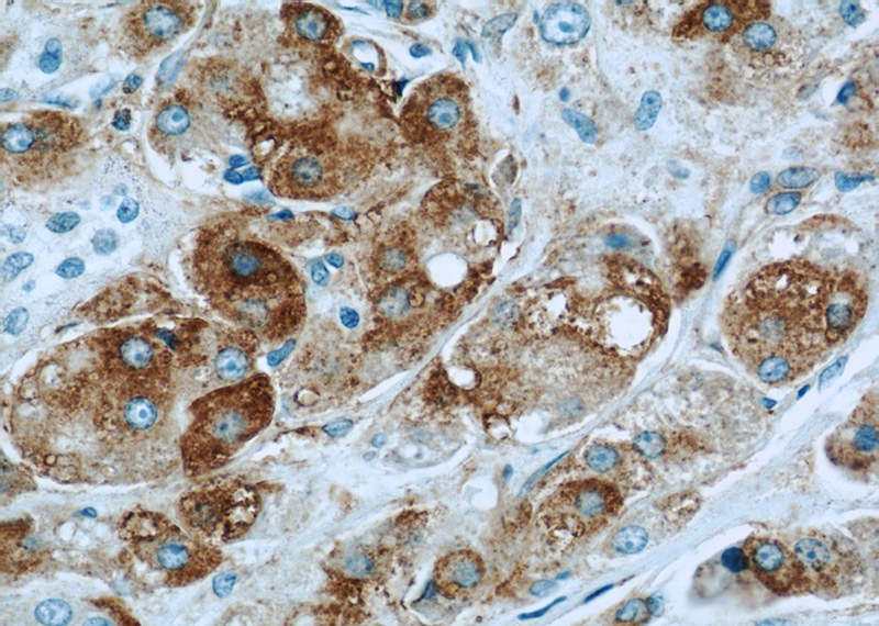 Immunohistochemistry of paraffin-embedded human breast cancer slide using Catalog No:117097(BCL2L12 Antibody) at dilution of 1:50