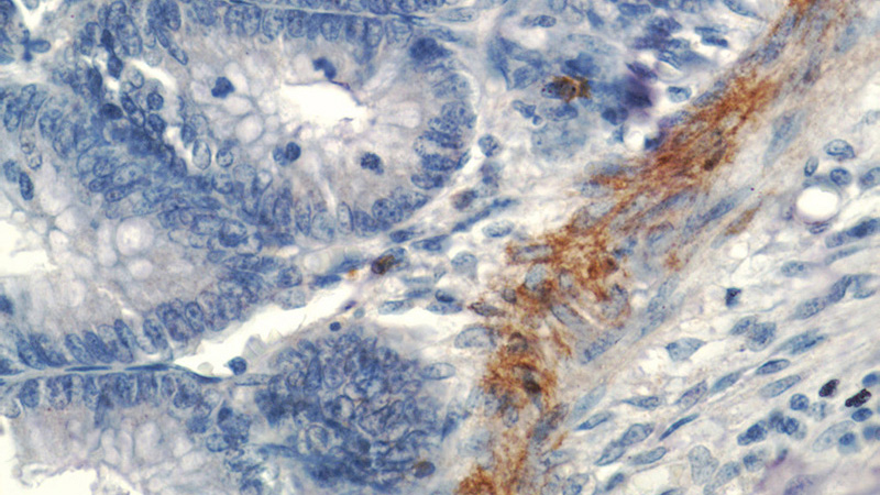 Immunohistochemistry of paraffin-embedded human colon tissue slide using Catalog No:107640(TAGLN Antibody) at dilution of 1:200 (under 40x lens)