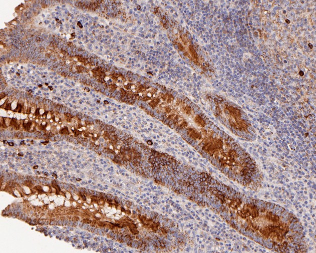 Fig4:; Immunohistochemical analysis of paraffin-embedded human appendix tissue using anti-ACAA2 antibody. The section was pre-treated using heat mediated antigen retrieval with Tris-EDTA buffer (pH 8.0-8.4) for 20 minutes.The tissues were blocked in 5% BSA for 30 minutes at room temperature, washed with ddH; 2; O and PBS, and then probed with the primary antibody ( 1/50) for 30 minutes at room temperature. The detection was performed using an HRP conjugated compact polymer system. DAB was used as the chromogen. Tissues were counterstained with hematoxylin and mounted with DPX.