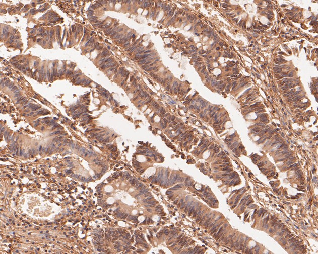Fig4:; Immunohistochemical analysis of paraffin-embedded human colon carcinoma tissue using anti-TMX4 antibody. The section was pre-treated using heat mediated antigen retrieval with Tris-EDTA buffer (pH 8.0-8.4) for 20 minutes.The tissues were blocked in 5% BSA for 30 minutes at room temperature, washed with ddH; 2; O and PBS, and then probed with the primary antibody ( 1/50) for 30 minutes at room temperature. The detection was performed using an HRP conjugated compact polymer system. DAB was used as the chromogen. Tissues were counterstained with hematoxylin and mounted with DPX.