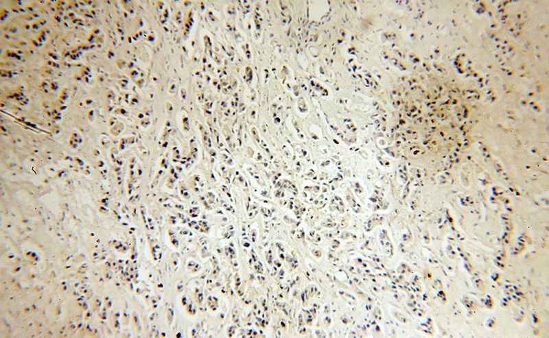 Immunohistochemical of paraffin-embedded human breast cancer using Catalog No:108388(BCL10 antibody) at dilution of 1:100 (under 10x lens)