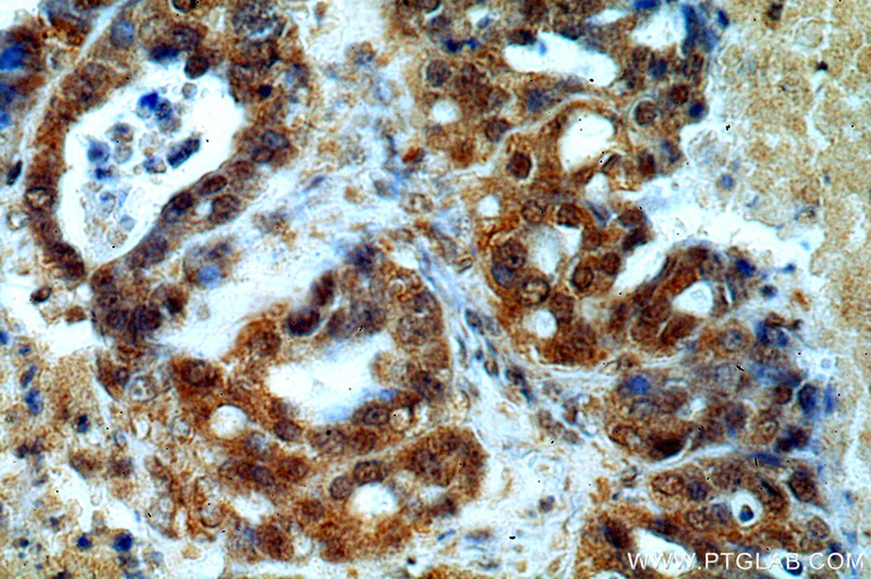 Immunohistochemical of paraffin-embedded human ovary tumor using Catalog No:107454(PAX8 antibody) at dilution of 1:50 (under 40x lens)